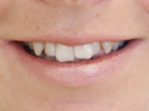 Aberdeen Dental Care - Invisalign